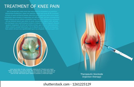 Realistic Illustration Treatment of Knee Pain. 3d Vector Image Banner Therapeutic Blockade Human Knee Joint. Syringe Injection. Medical Poster Procedure and Result Treatment with Injection Therapy.