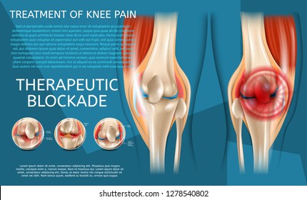 Realistic Illustration Treatment of Knee Pain. 3d Vector Image Banner Therapeutic Blockade Human Knee Joint. View Before and After Medical Treatment. Visualization Knee from Different Angles