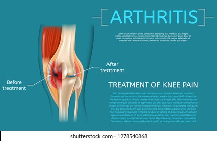 Realistic Illustration Treatment of Knee Pain. Medical Benefit Demonstrating Structure Knee Before and After Arthritis Treatment Detailed Structure Leg Joint. 3d Vector Image Banner Anatomy Human Knee