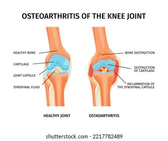 Realistic infographics with anatomy of healthy knee and osteoarthritis of joint with labelled parts vector illustration