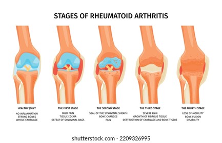 Realistic infographics showing four stages of rheumatoid arthritis of knee joint vector illustration