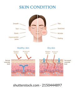 Realistic infographics showing structure of human healthy and dry skin with normal and decreased ceramide level vector illustration