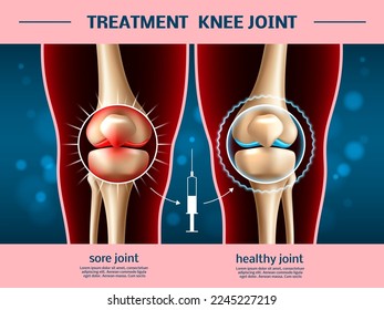 Realistic knee joints. Osteoarthritis treatment, anti inflammatory injection, 3d anatomical part, leg bones and cartilage infographic, educational anatomy medical poster, utter vector concept