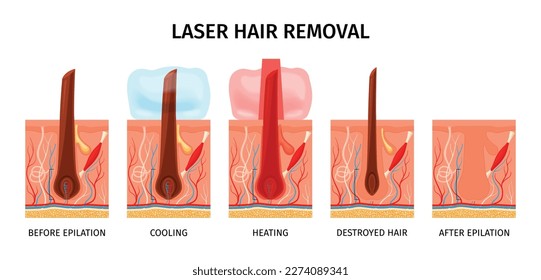 Realistic laser hair removal composition with isolated profile views of scalp during laser removal epilation procedure vector illustration
