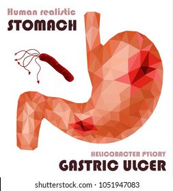 Realistic low poly human stomach and duodenum. Pain stomach, ulcer diseases, helicobacter pylori bacteria virus attack. Gastric ulcer abstract concept. Vector.