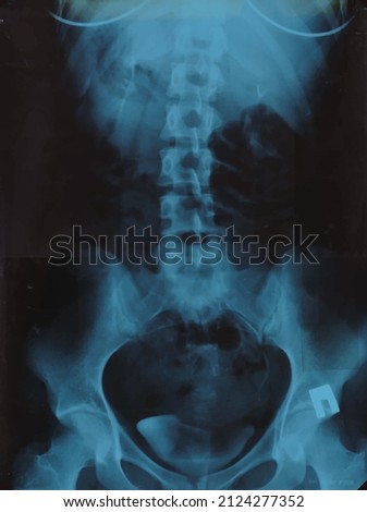 Realistic Lumbar spine x ray, pelvic bones MRI scan picture. Vector illustration