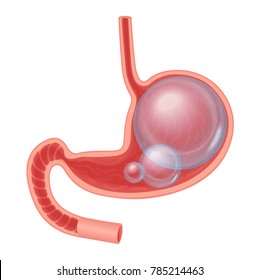 Realistic Medical Illustration Of Abdominal Bloated Stomach Isolated. Transperant Ball Inside Stomach.