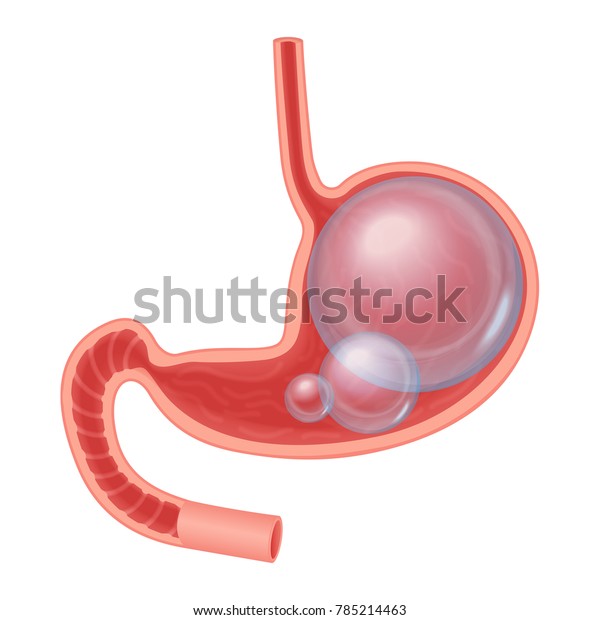 腹部膨満胃の写実的な医療イラスト 胃の中の透過球 のベクター画像素材 ロイヤリティフリー