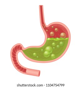 Realistic medical illustration of nausea stomach isolated. Green liquid inside stomach.