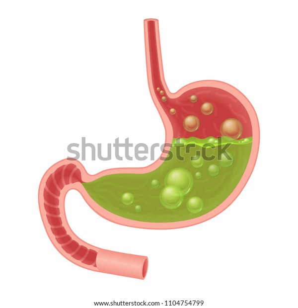 吐き気胃のリアルな医療イラスト 胃の中の緑色の液体 のベクター画像素材 ロイヤリティフリー