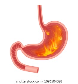 Realistic medical illustration of pyrosis stomach isolated. Fire disorder inside stomach.