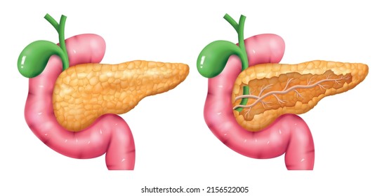 Realistic pancreas anatomy set with isolated images of normal and damaged pancreas with colored limb parts vector illustration