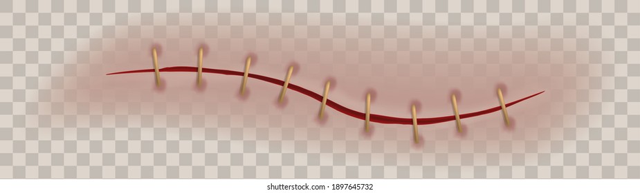 Realistic scar or wound. Bloody surgical sutures healing stitch, stitched gash closeup texture. Medical curing steps operation on human body, vector isolated on transparent background 3d illustration