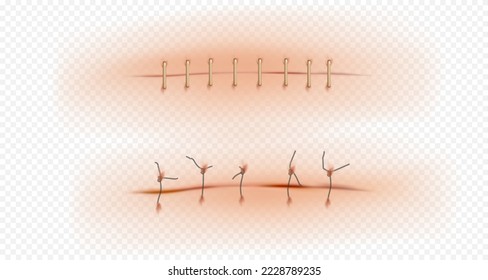 Realistic scars. Medical surgical sutures wounds close up pictures on human skin decent vector illustrations set
