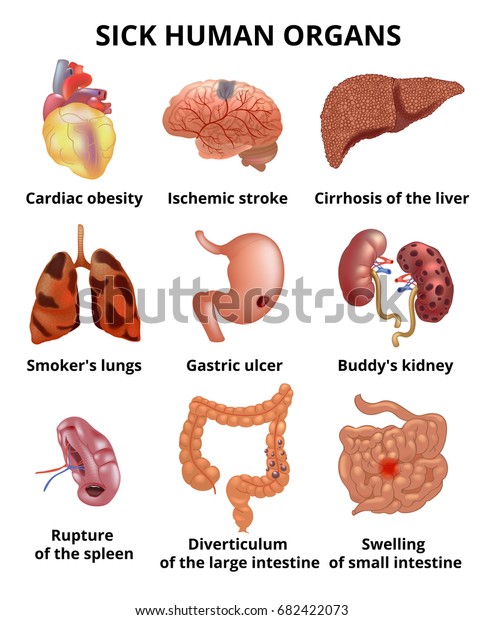 Realistic Sick Human Organs Set Anatomy Stock Vector (Royalty Free ...