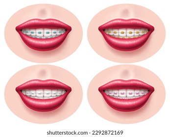 Realistic teeth dental braces. Smiling lips, orthodontic bite correction, tightening structures, different types metal, ceramic and sapphire, , health and beauty utter vector 3d isolated set