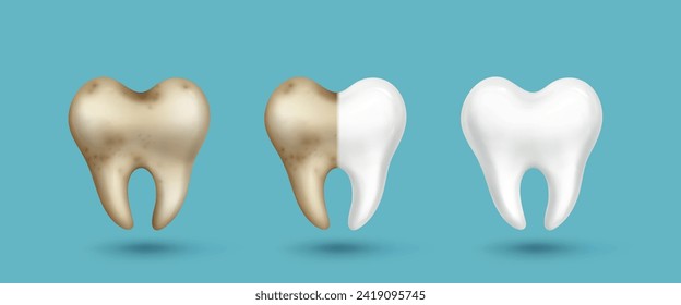 Realistic tooth before and after cleaning procedure at dentist - dirty gray and yellow with stains and clean white shiny. Vector set of bad and healthy teeth for dental care and hygiene design.