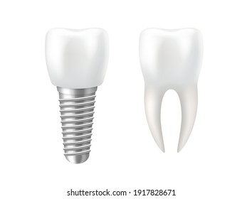 Realistic tooth and dental implant for stomatology or dentistry template, 3d rendering. Shiny healthy tooth and implant isolated. Vector illustration