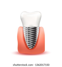 Realistic tooth implant with metallic screw in pink gum on white