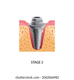 Realistic tooth stages dental implant composition with text and view of third stage of dental implantation vector illustration