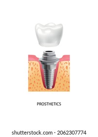 Realistic tooth stages dental implant composition with text and view of prosthetics stage of dental implantation vector illustration