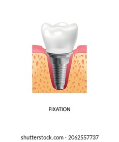 Realistic tooth stages dental implant composition with text and view of fixation stage of dental implantation vector illustration