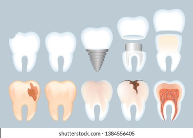 Realistic Tooth Structure Vector Illustration. Close-up Structure Teeth. Healthy Natural Tooth and its Destruction. Problems with Enamel. Healthy Dental Implant and its Structure 3d.