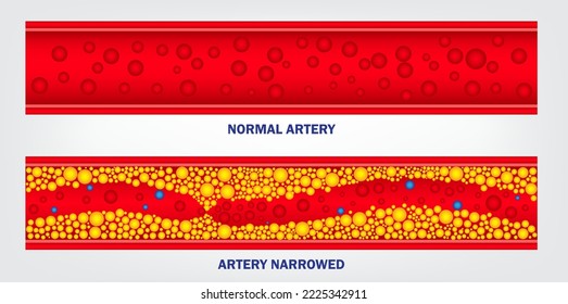realistic type of cholesterol in artery isolated. eps vector