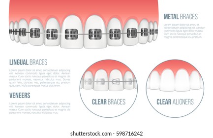 Realistic upper jaw with healthy tooth and dental braces. All types of braces: metal, lingual, clear braces and clear aligners. Vector illustration with place for your text
