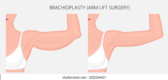 Realistic Vector illustration. Brachioplasty or Upper-Arm Lift plastic surgery in woman. Front view. For advertising of esthetic cosmetic procedures after weight loss; for medical publications. EPS 8.