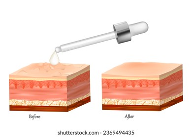 Ilustración vectorial realista con piel sana y dañada. Piel seca e hidratada. С sección transversal de una epidermis y desmis capas de piel. Cuidar el rejuvenecimiento de la piel. 