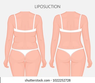 Realistic Vector illustration. Liposuction, waist, hips, buttocks and thighs plastic surgery in woman.Back view. For advertising of esthetic cosmetic procedures; for medical publications. EPS 8.