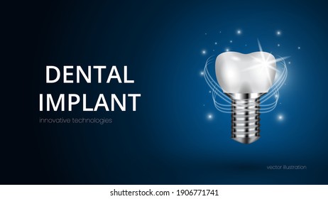 Realistic white dental implant on a blue background with text. Vector 3d model of a tooth with carving