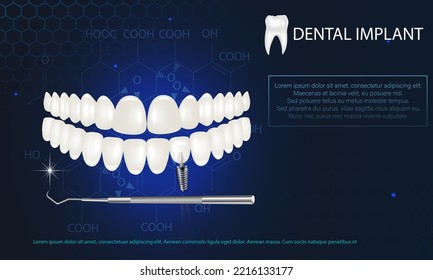 Realistic white dental implant on a blue background. Vector 3d model of a tooth with a thread.