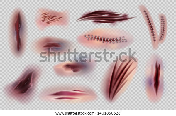Realistic wounds and stitches. Cut skin
and body marks and scratches isolated, bruises and injuries. Vector
illustration body scars and skin wound
set