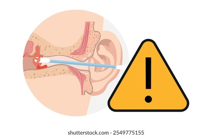 The reason not to use q-tip for earwax removal