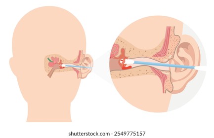 The reason not to use q-tip for earwax removal