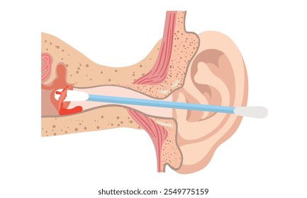 The reason not to use q-tip for earwax removal