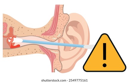 The reason not to use q-tip for earwax removal