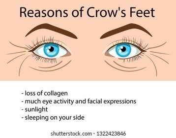 Reasons od Crows feet wrinkles, vector illustration