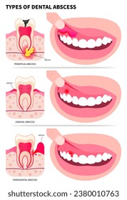 Klassifizierung von Zahnfleisch, das zu Zahnbluten und Gingivitis führt