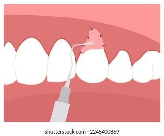 Recession gummy smile dentistry root canal decay toothache swelling Teeth grafting procedure for buildup Loose black cavity abscess oral pain thin injury cosmetic recontouring crown prep