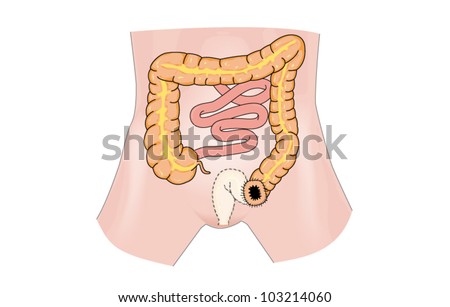 Rectal cancer and stoma