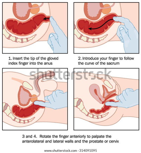 骨盤腔と検査官の指の断面を示す男性と女性の両方の患者の直腸検査法 のベクター画像素材 ロイヤリティフリー