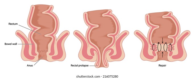 Rectal prolapse operation, showing normal bowel anatomy, prolapsed rectum and rectal repair. Created in Adobe Illustrator.  Contains transparencies.  EPS 10.