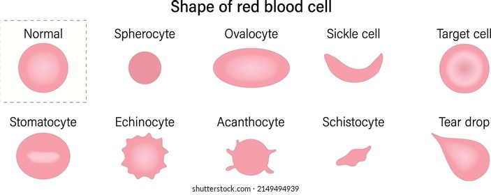 Red blood cell morphology. Shape of red blood cell. Spherocyte, Ovalocyte, Sickle cell, Target cell, Stomatocyte, Echinocyte, Acanthocyte, Schistocyte and Tear drop.