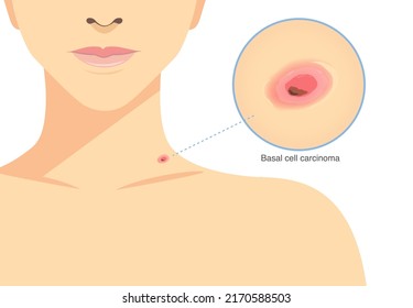 Red bump is Basal cell carcinoma on the woman's neck. Illustration about skin cancer, medical and health checks.