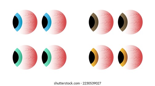 Ojos rojos de diferentes colores. Estrés por enfermedad, insomnio por sueño, capilares y pupilas.