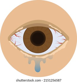 Red eyes, inflammation, tearing, pus, conjunctivitis in humans. Conjunctivitis, eye disease. Vector image of conjunctivitis. Red eye with disease.