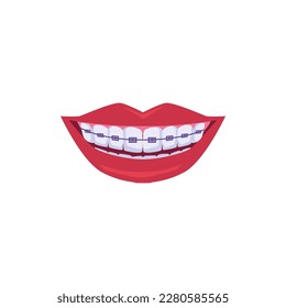 Red lips smiling with purple dental braces, flat vector illustration isolated on white background. Correction of underbites, overbites and crooked teeth. Orthodontic dentistry concept.